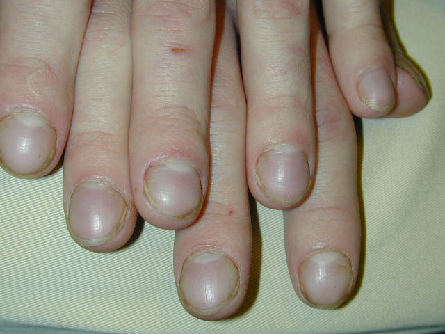 Clubbing of the fingernails. Can also occur with the toenails